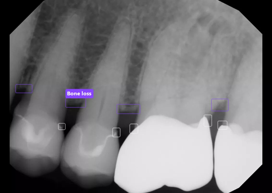 Bone Loss