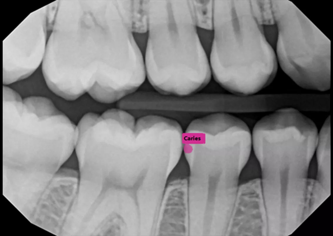 Caries