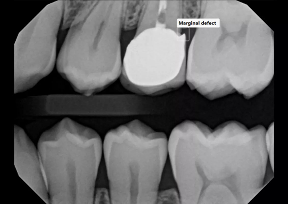Discrepancy at margin of existing restoration