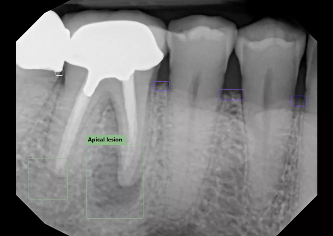 Periapical Radioluceny