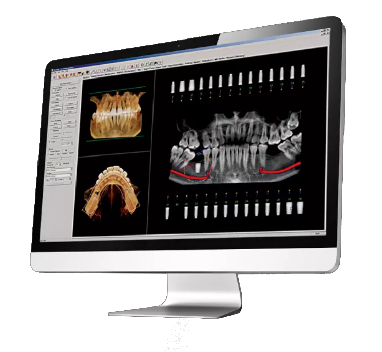 Osteoid Software Options