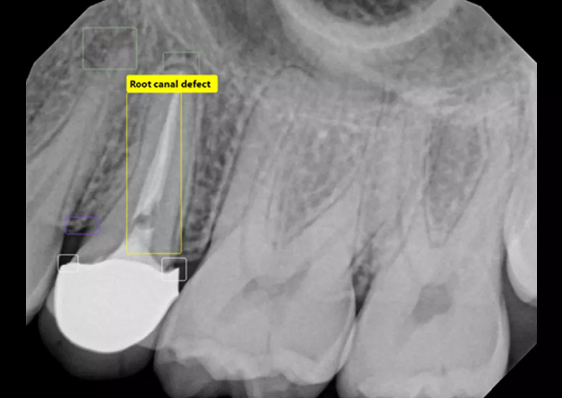 Root Canal Filling Deficiency