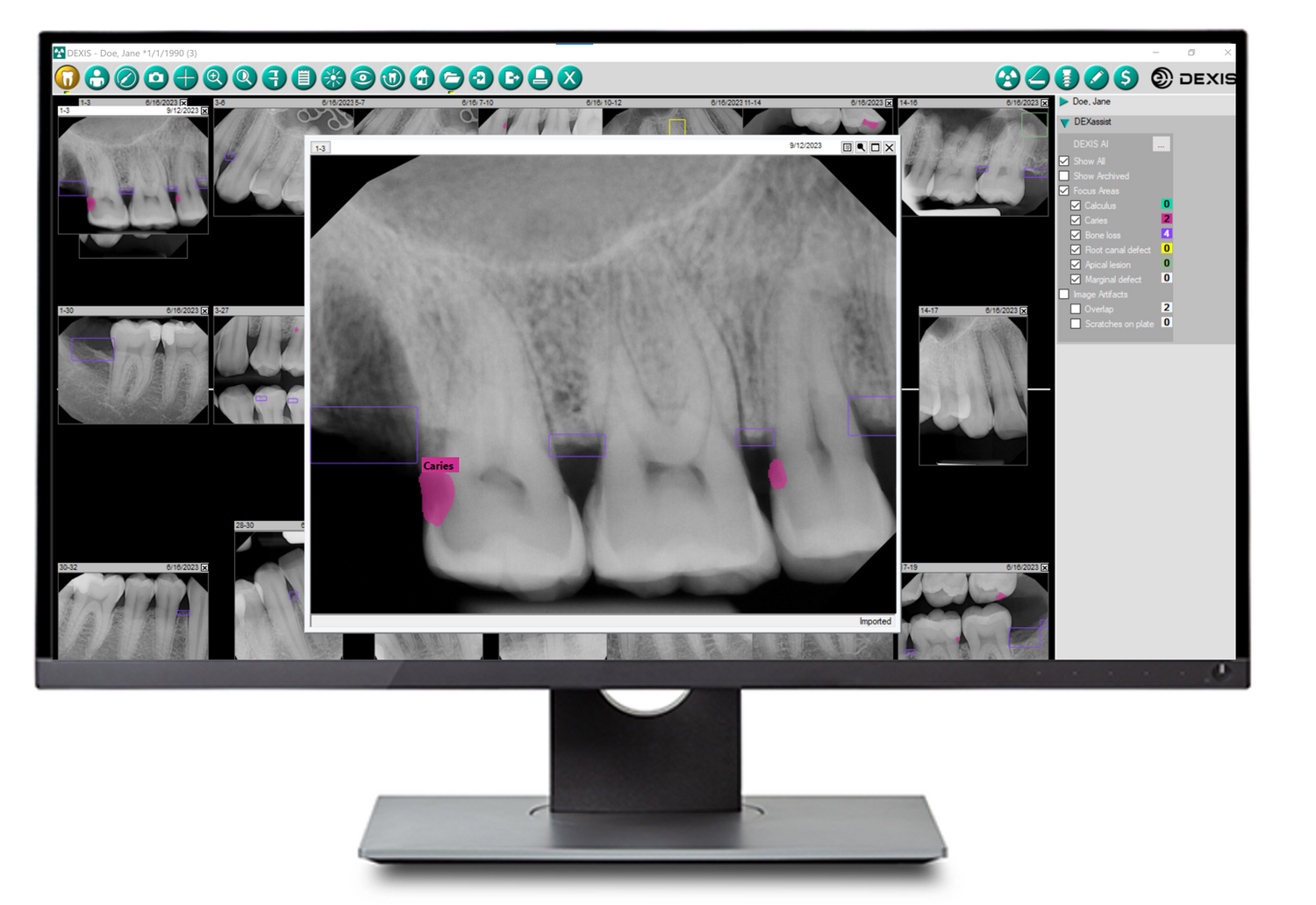 2D AI Dental Findings Overview – DEXIS Shop